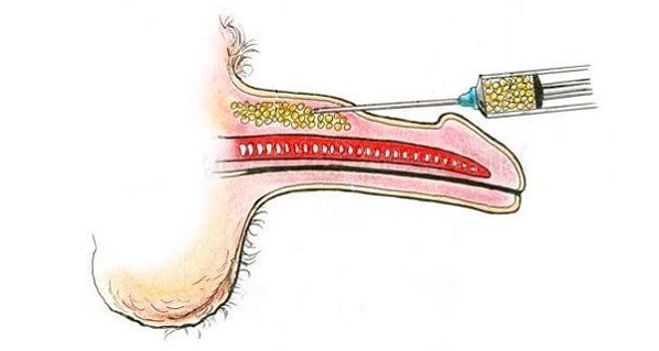 Injektiounen vum Hyalurony Saier an d'Faass vun engem Member fir et z'erhéijen